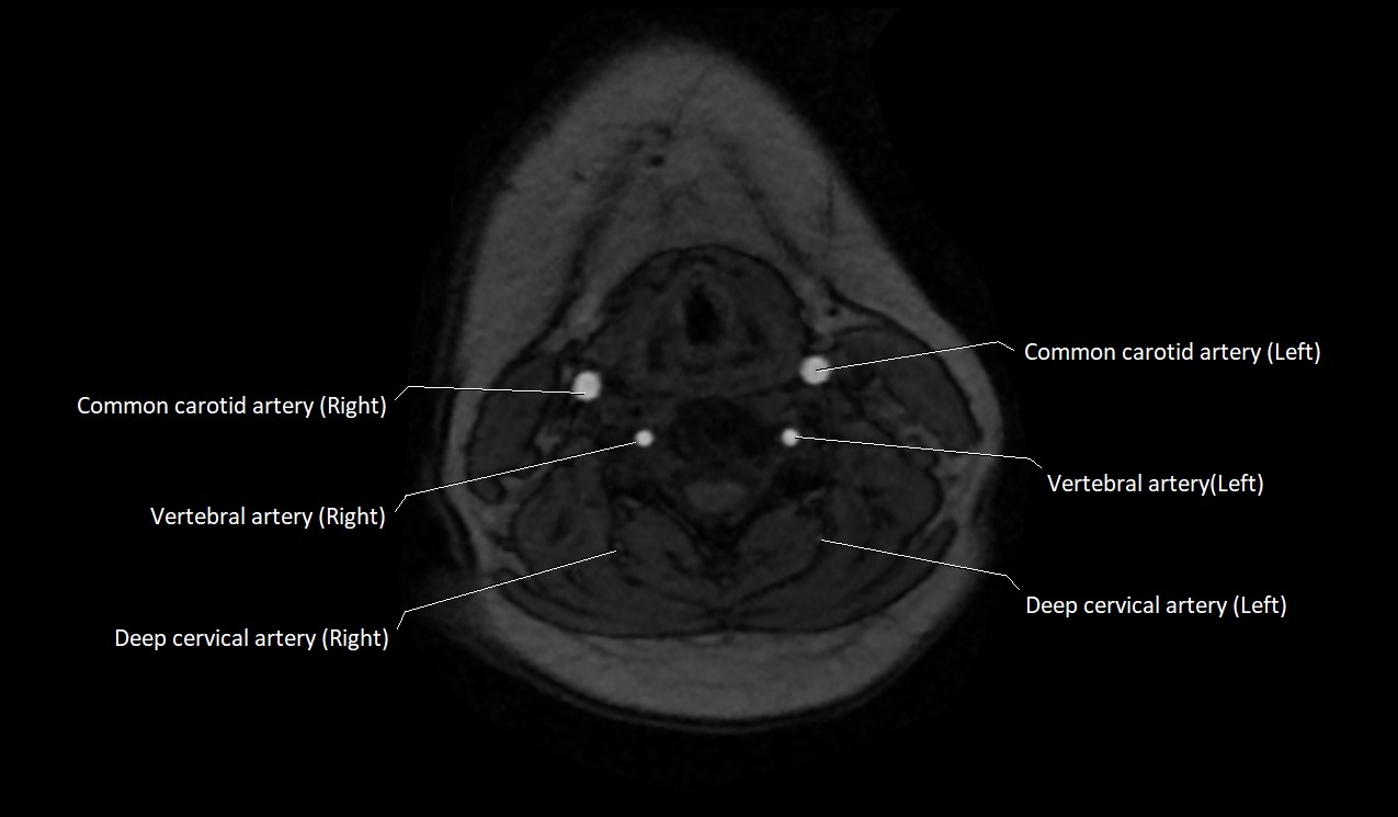 Carotid artery anatomy axial 3T image 37.jpg
